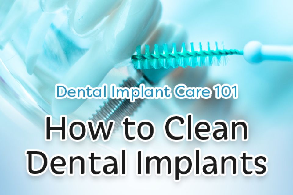 How To Clean Dental Implants: Dental Implant Care 101